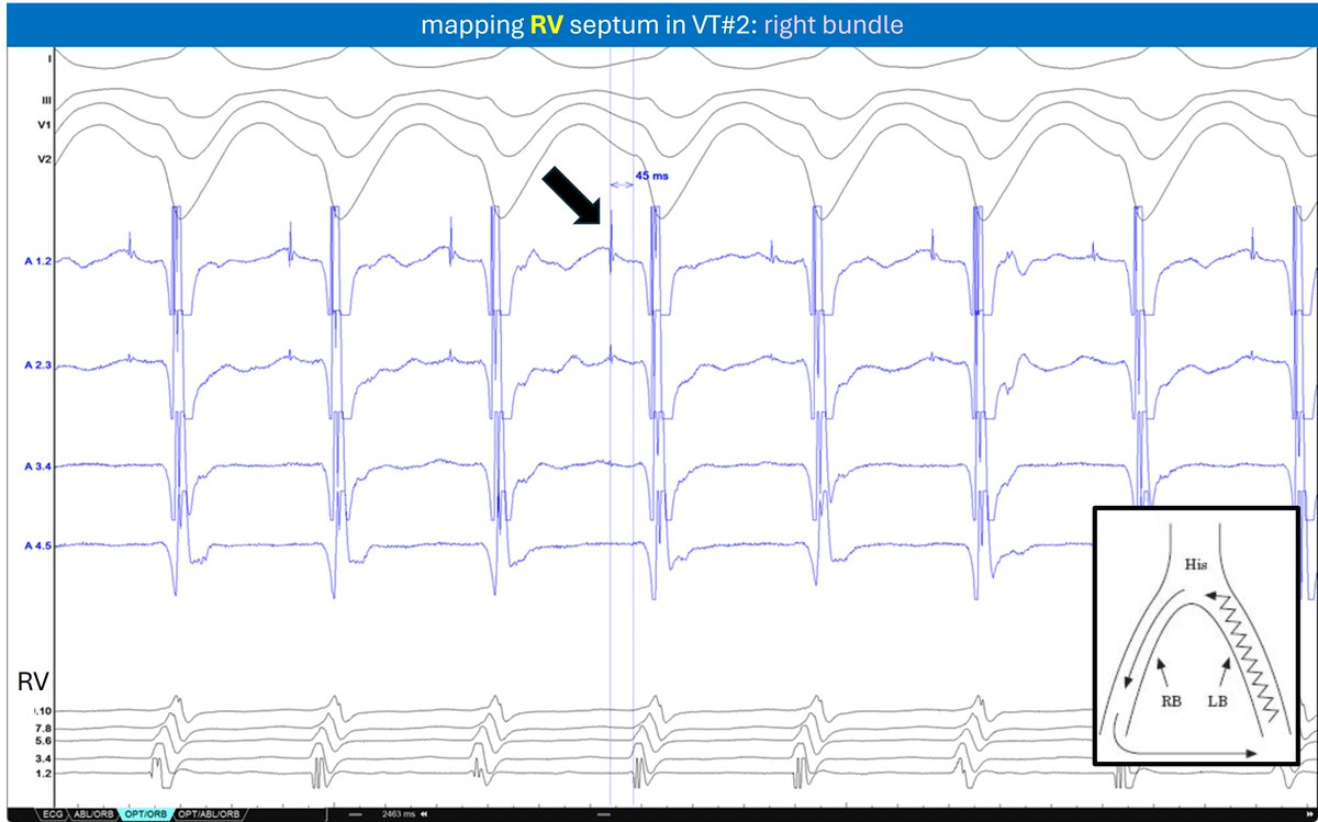 BUNDLE BRANCH VTs, regular (VT2) and reverse (VT1)‼️, with normal HV interval. Bileaflet aortic valve + stenosis (requiring AVR). See conduction system EGMs preceding QRS in both VTs. Carto map 👇🧵
#Epeeps #AblateVT <a href="/EF_Cardiaca/">EfectoElectrotónico</a> <a href="/pjsm83/">Pablo Sánchez Millán</a>