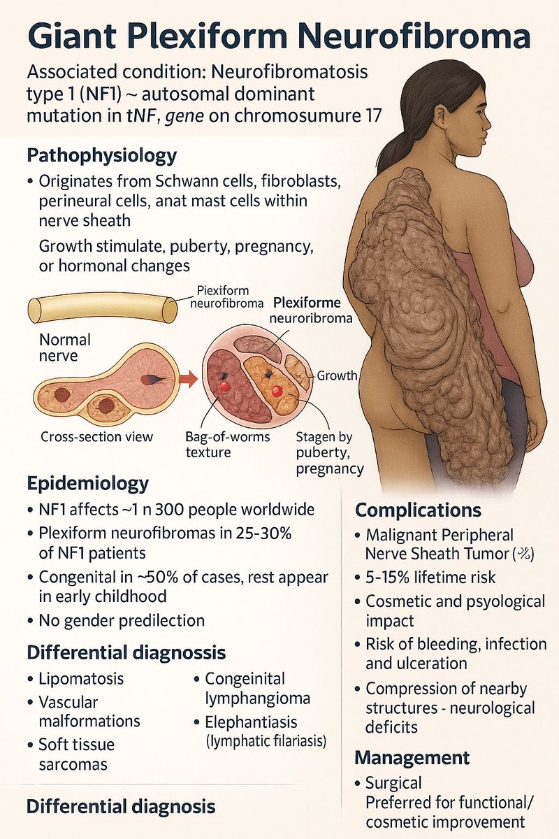 Giant Plexiform Neurofibroma 🧠 

🗣️🗣️🗣️