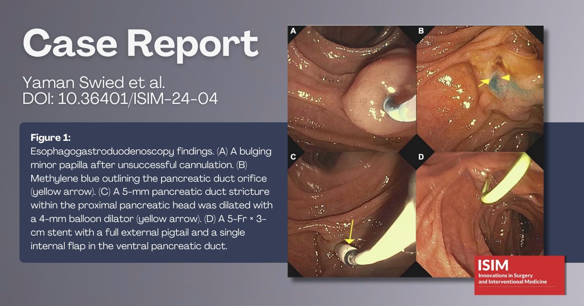 In an #ISIMJournal case report, Swied et al. highlight the feasibility of #methyleneblue as an adjunct in upper endoscopic interventions doi.org/10.36401/ISIM-… #endoscopicintervention #gastricfistula