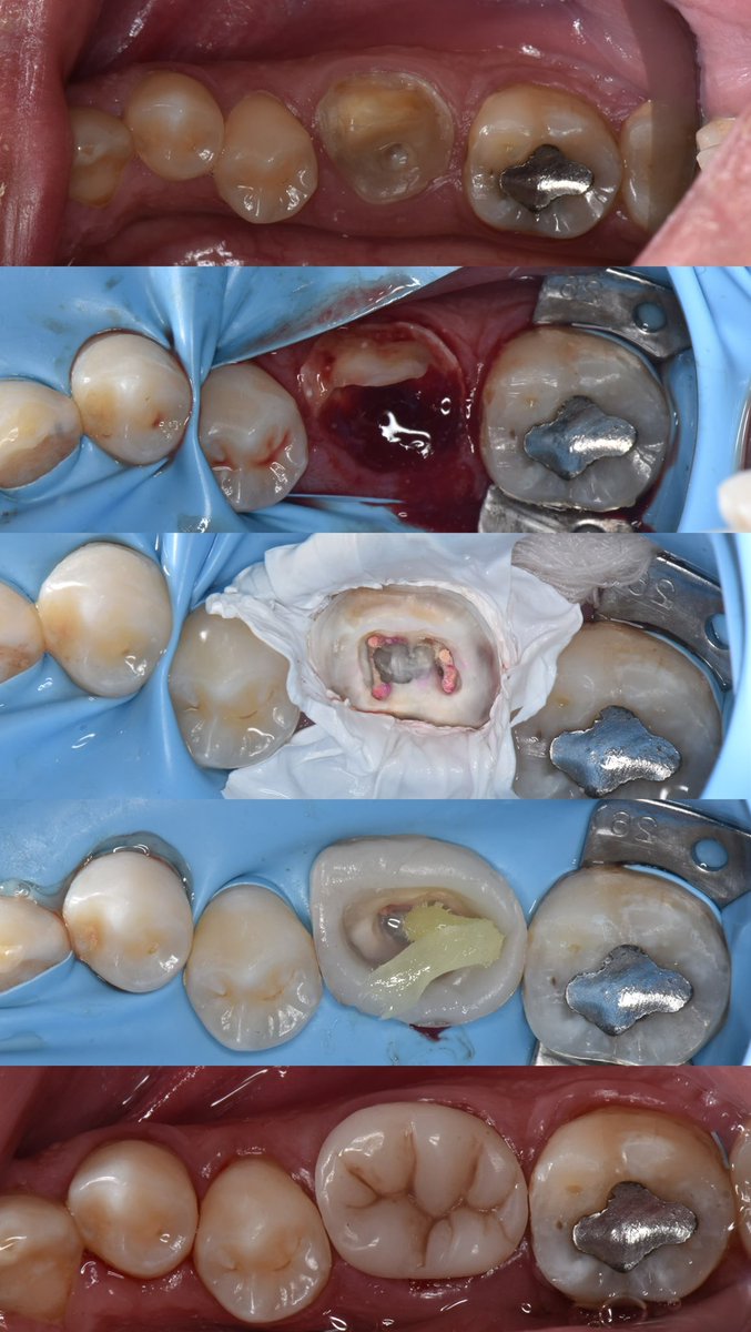 Drsaadaldossary's tweet photo. من تركيبة ساقطة إلى حشوة دائمة أناتومية ونظيفة 👌🦷
الحالات الصعبة تتحول لنتيجة جمالية ووظيفية مع الدقة والخطوات الصحيحة 🩵 https://t.co/ktb0XRelSZ