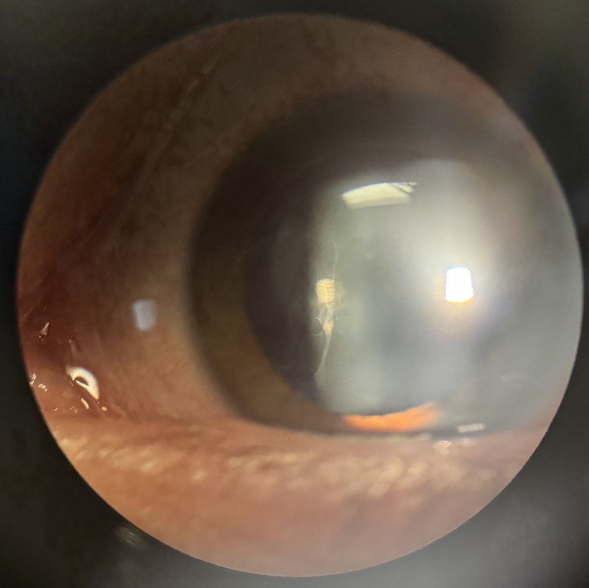Asymptomatic “stalk-like” vitreous opacity in a patient with persistent fetal vasculature. Note small Bergmeister papilla at the inferotemporal disc margin and a Mittendorf dot on the lens.