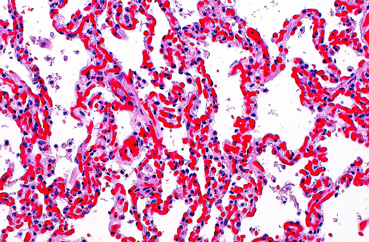 🔬📷 Pulmonary Congestion ~ Alveolar capillaries packed with red