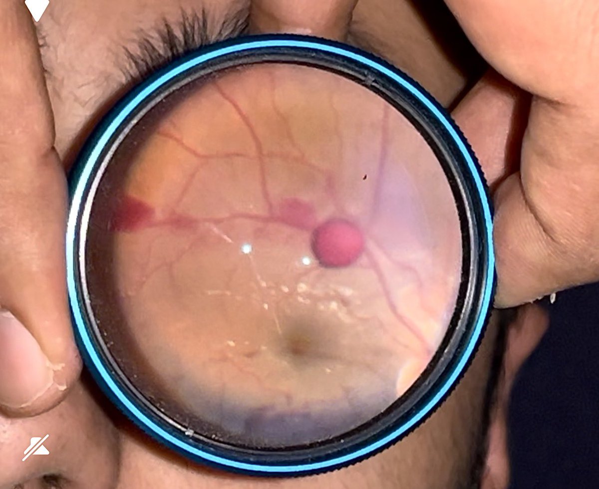 A 🔴 on the Retina caused by a ⚽️ on the Face. 

What else can Blunt trauma cause?? 
What else needs to be ruled out ?? 

#Ophthalmology #MedTwitter #EyeTrauma