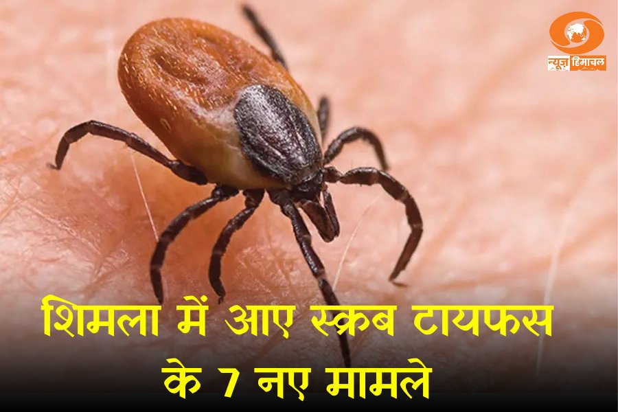 DDNewsHimachal's tweet image. शिमला : IGMC में 17 सैंपल में से 7 नए स्क्रब टायफस के मामले आए सामने, लोगों से सतर्क रहने की अपील। 

#himachalnews #shimla #igmc #scrubtyphus