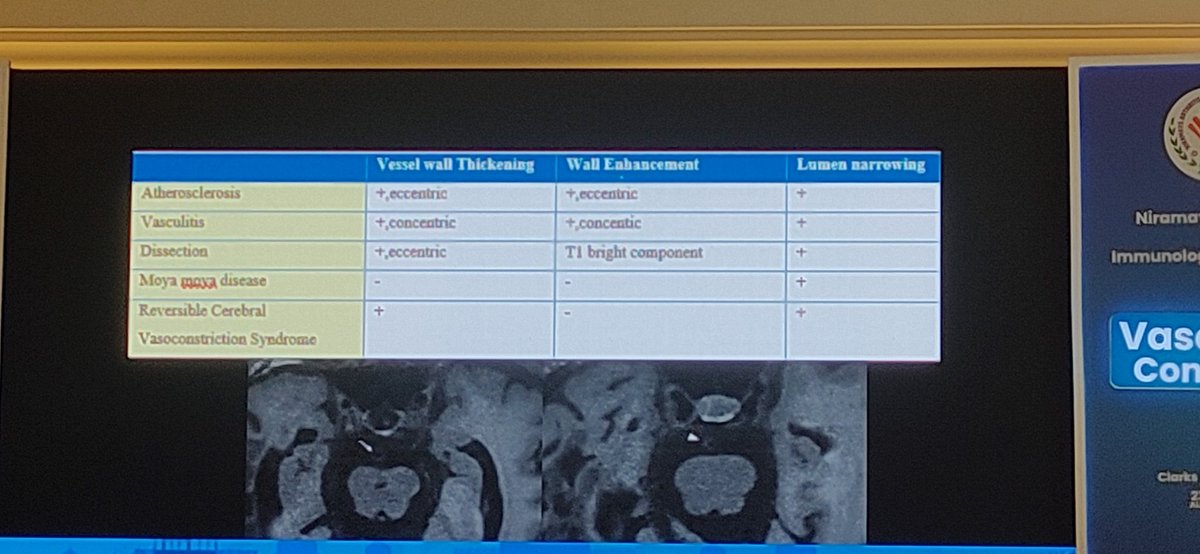 Vasculitis Imaging-MRI
Best Tool: Black Blood MRI → direct vessel wall view.
Hallmark: Concentric wall thickening + strong enhancement.
D/D's:
Atherosclerosis-eccentric
RCVS-no enhancement
Dissection-eccentric + T1 bright
Recommendation: Use HRVW MRI for suspected CNS vasculitis