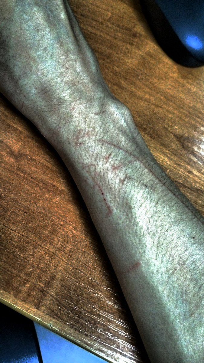 kimirittoz's tweet image. look at the scars my cat gave me