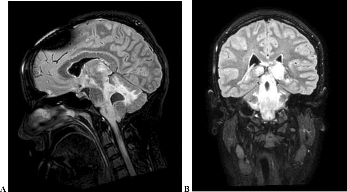 A 30-year-old woman, 3 months post-partum, is admitted after 10 days of headache, vomiting, dizziness and impaired consciousness. She suffers a generalized seizure and requires intubation. Labs show leukocytosis with low CRP. Blood cultures are negative.

What would you consider?