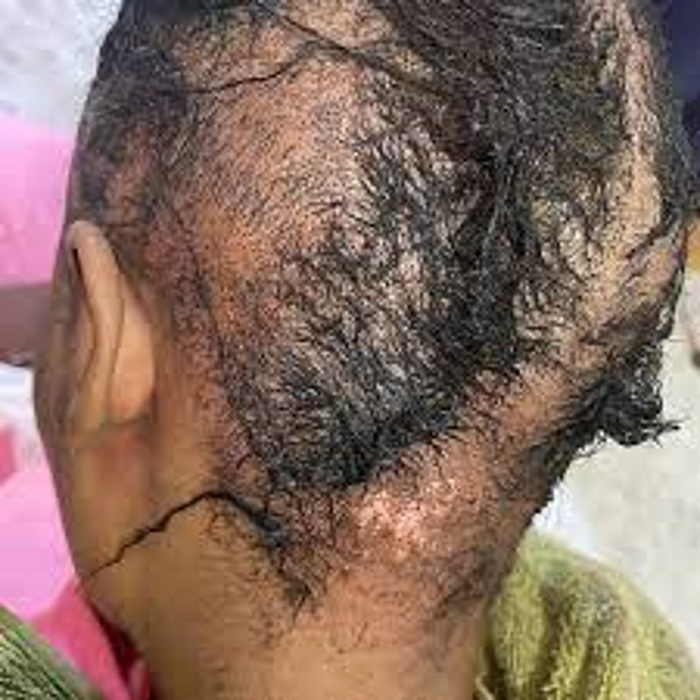 If you have suffered an injury from using a hair relaxer, it is important to seek legal assistance from a knowledgeable and experienced personal injury lawyer. Contact Hearn Law Firm today
hearnlawfirm.net 
 #HairCareLegal #RelaxedHairAttorney #ChemicalBurnLawyer