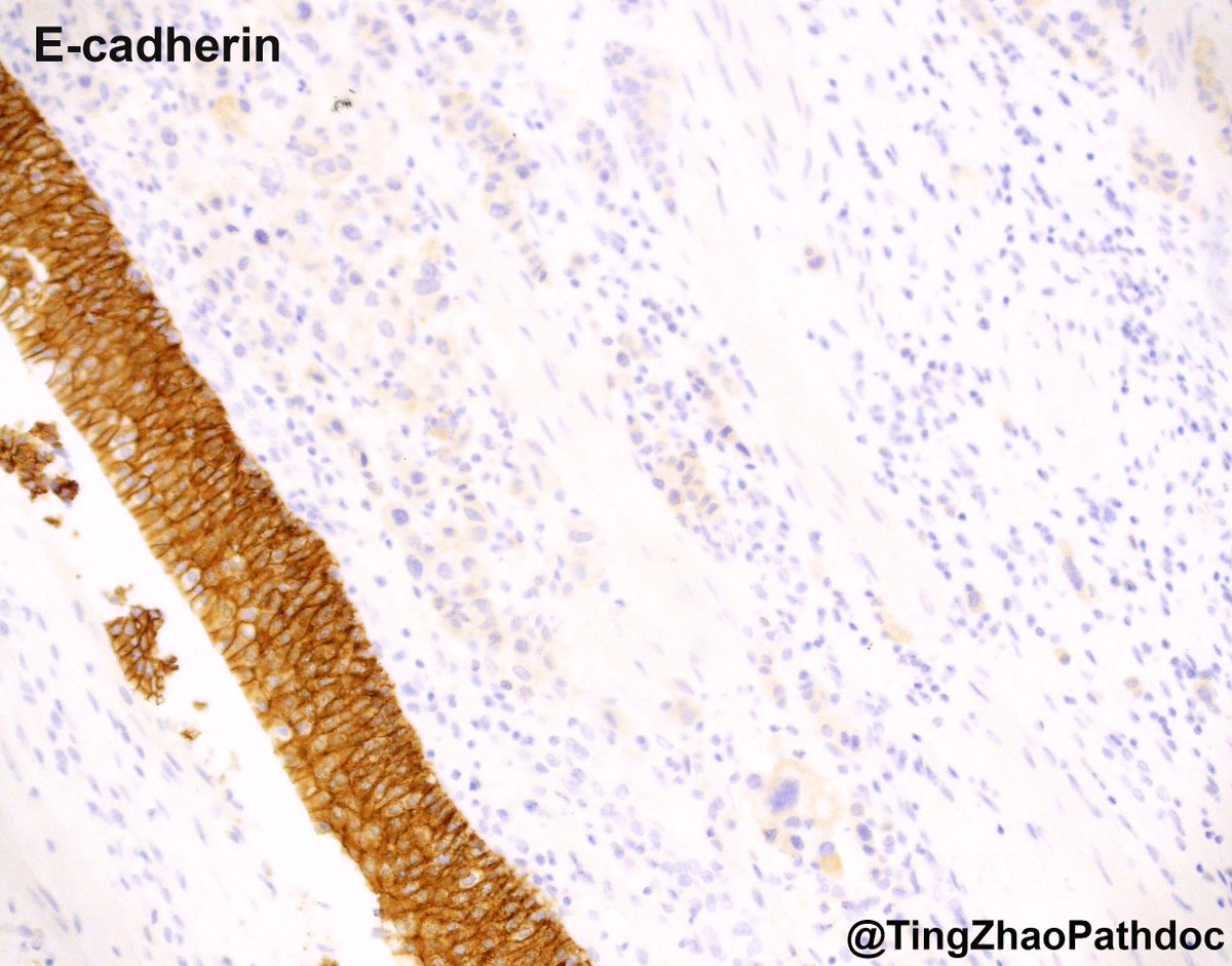 Ting Zhao, MD (@tingzhaopathdoc) on Twitter photo <a href="/MGBpathology/">Mass General Brigham Pathology</a> <a href="/MGHPathology/">MGH Pathology</a> Plasmacytoid Urothelial Carcinoma #GUpath
▶️Single infiltrating cells, frequent eccentrically placed high-grade nuclei
▶️Photo 4: extravesical tumor directly invades prostatic stroma and seminal vesicles➡️pT4a
▶️Photo 3: tumor spreads along the prostatic urethral mucosa (surface <a href="/MGBpathology/">Mass General Brigham Pathology</a> <a href="/MGHPathology/">MGH Pathology</a> Plasmacytoid Urothelial Carcinoma #GUpath
▶️Single infiltrating cells, frequent eccentrically placed high-grade nuclei
▶️Photo 4: extravesical tumor directly invades prostatic stroma and seminal vesicles➡️pT4a
▶️Photo 3: tumor spreads along the prostatic urethral mucosa (surface