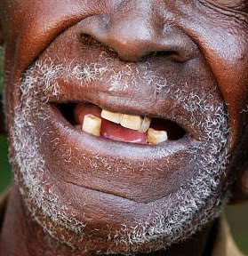 republiqueBRA's tweet image. 😬 ✊🏿 Lula reclama de propaganda do governo federal com homem negro sem dentes, preparada por um antigo ministro para um evento na Alemanha:

🗣️ “Eu chamei o ministro e perguntei: ‘Escuta aqui. Por que você colocou essa fotografia desse senhor negro sem dente? Você acha isso…