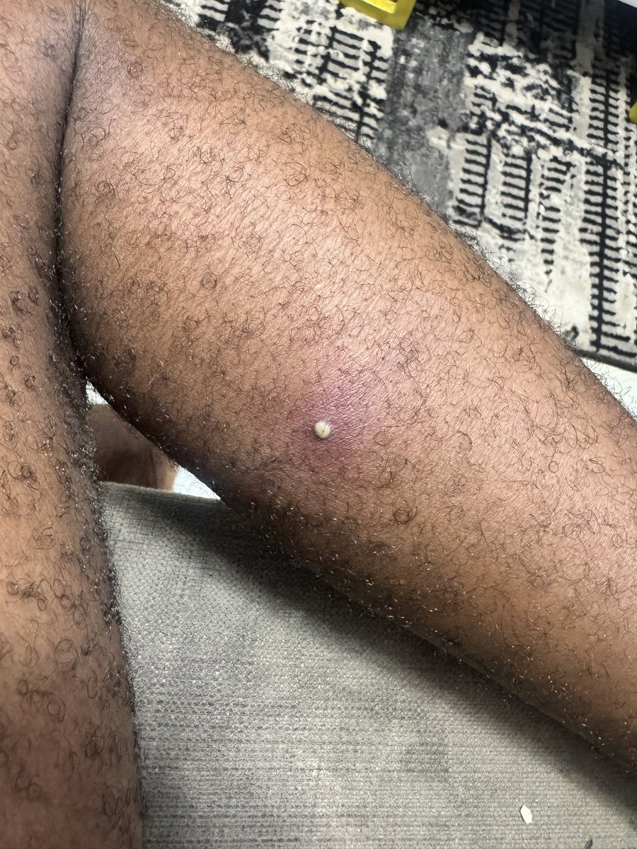 TheRoyalHerbs's tweet photo. Some people see something like this on their body and quickly believe it’s normal boil until it got worst. Those that survived it would quickly understand what it is.

God is the greatest, thank you God 🤲🏻🤲🏻🤲🏻

Just posting incase you see anything like this on you, please don’t burst it, seek direction and guidance from Elders✌🏻✌🏻✌🏻
