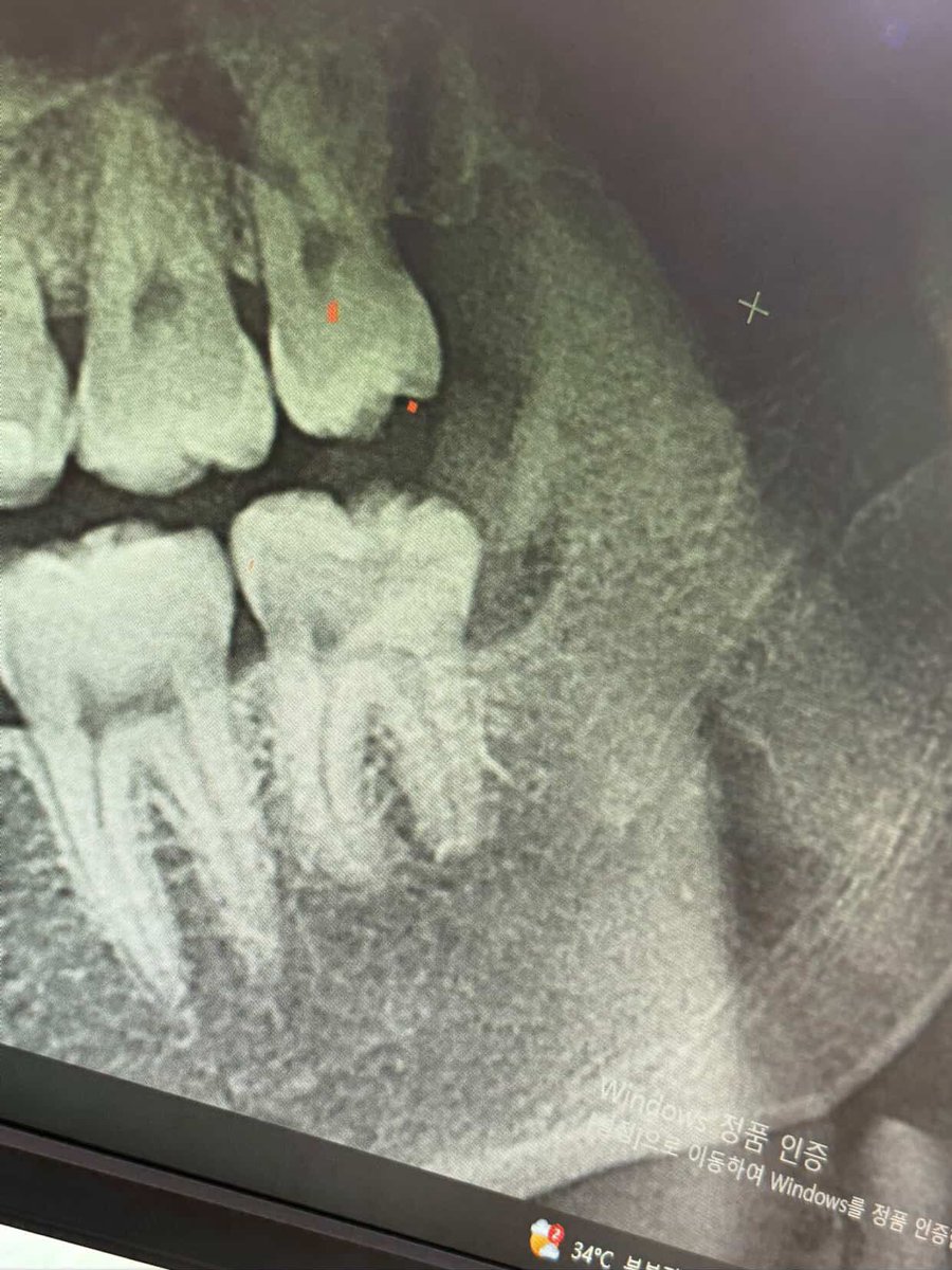 TongzTongz_'s tweet image. ถ้านี่ไม่ใช่ศิลปินที่เรียลและจริงใจที่สุด 55555555555 แจ็คโว้ยยยยยย 55555555  สงสารก็สงสารแต่ขอแอบขำด้วย😂 ให้ดูยันฟิล์มเอ็กซเรย์ฟันไปเลยจบๆ #JacksonWang @JacksonWang852