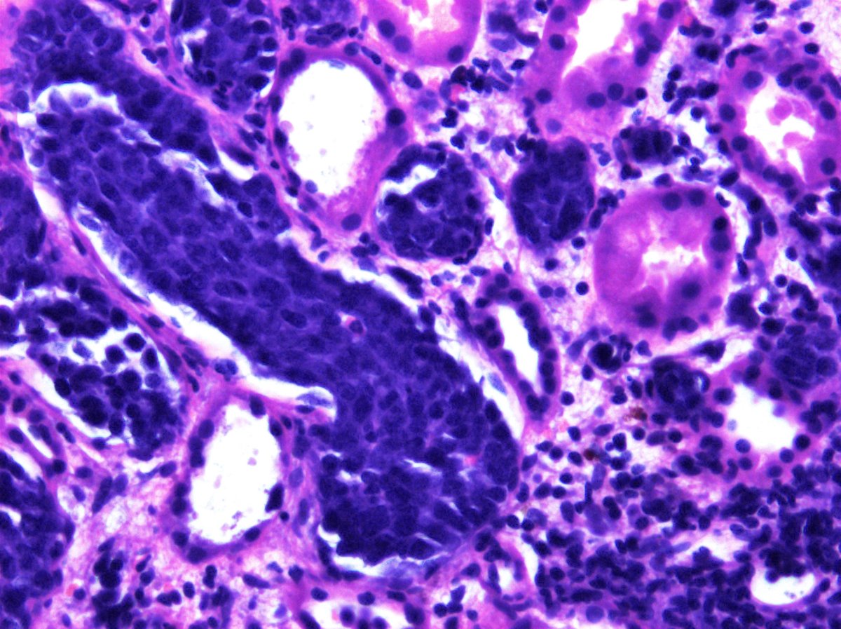 #hemepath Interesting case...kidney biopsy