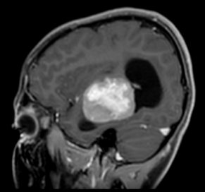 👧A 14-year-old girl presents with progressive right-sided hemiparesis over 4 months. No fever, weight loss, or lymphadenopathy. Exam: mild dysphasia, right hemiparesis, Babinski positive.

👨‍⚕️What would be your differential?
