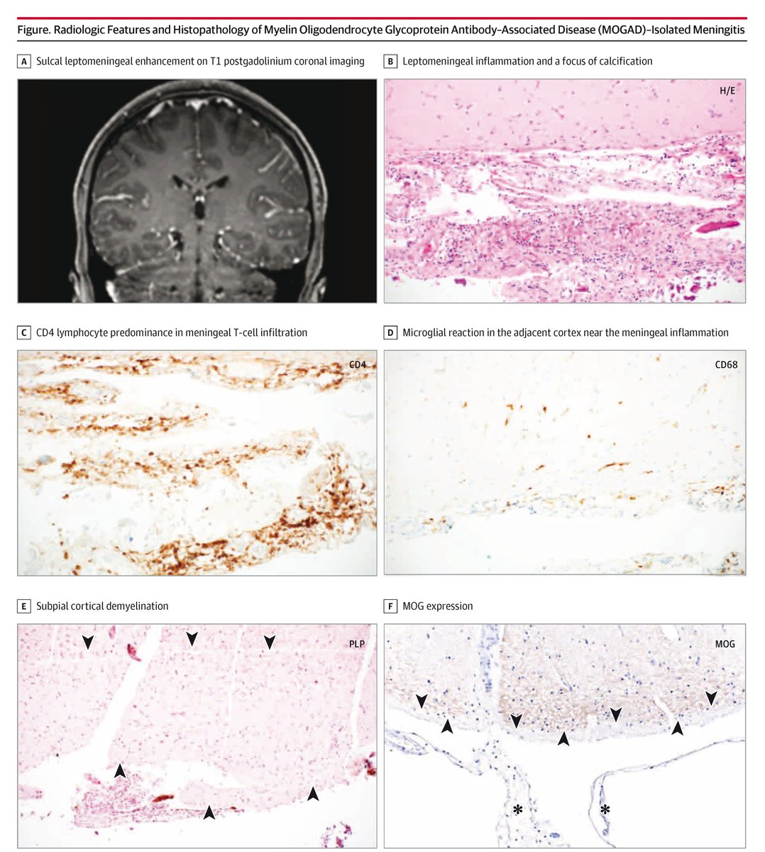 JAMA Neurology (@jamaneuro) on Twitter photo Meningitis may sometimes be an early sign of meningoencephalitis or parenchymal disease, with lesions not yet visible due to radiologic delay. ja.ma/4fqn5qP <a href="/EoinFlanagan14/">Eoin Flanagan</a>, <a href="/albertaboseif/">Albert Aboseif</a>, <a href="/marignierro/">Romain Marignier</a> Meningitis may sometimes be an early sign of meningoencephalitis or parenchymal disease, with lesions not yet visible due to radiologic delay. ja.ma/4fqn5qP <a href="/EoinFlanagan14/">Eoin Flanagan</a>, <a href="/albertaboseif/">Albert Aboseif</a>, <a href="/marignierro/">Romain Marignier</a>