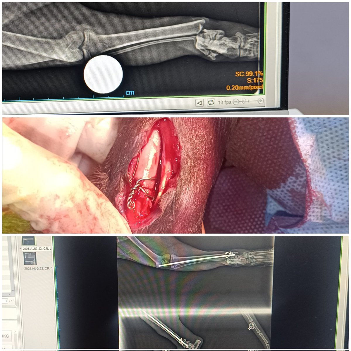 Bugünkü vakamız: tibia-fibula fraktürü 🦴
Operasyon öncesi ve sonrası farkı görmek bile insanı mutlu ediyor 🙏
Intramedüller pin + cerclage telleri ile başarılı bir şekilde stabilize ettik.
Minik dostumuzun kısa sürede sağlığına kavuşması için süreci yakından takip ediyoruz 🐾❤️