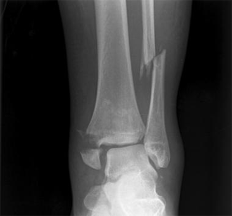 omarsery1's tweet photo. #Celiakie zvyšuje riziko zlomenin kvůli osteoporóze celkově o 30 - 43% (kyčel, páteř, zápěstí, pažní kost), #zlomenina krčku stehenní #kosti je u osob s celiakií o 63% častější (Duerksen et al., 2021). https://t.co/E3C1aFyXwy
