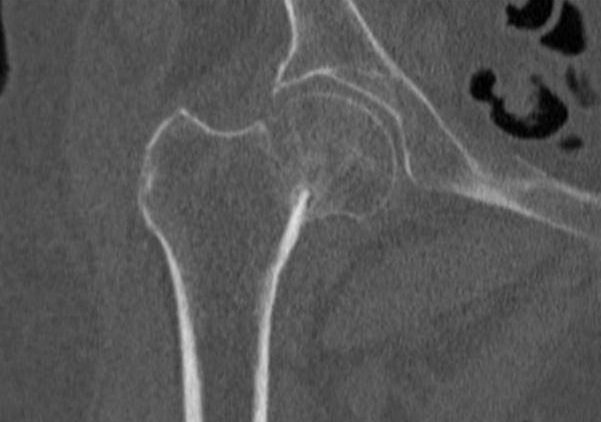 omarsery1's tweet photo. #Celiakie zvyšuje riziko zlomenin kvůli osteoporóze celkově o 30 - 43% (kyčel, páteř, zápěstí, pažní kost), #zlomenina krčku stehenní #kosti je u osob s celiakií o 63% častější (Duerksen et al., 2021). https://t.co/E3C1aFyXwy