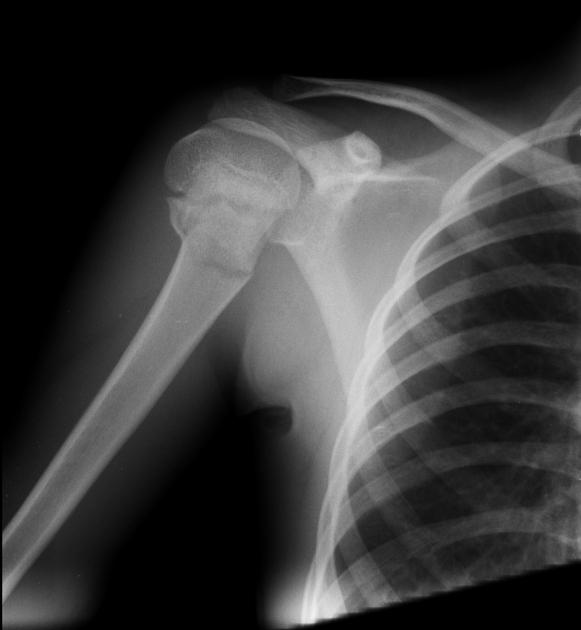 omarsery1's tweet photo. #Celiakie zvyšuje riziko zlomenin kvůli osteoporóze celkově o 30 - 43% (kyčel, páteř, zápěstí, pažní kost), #zlomenina krčku stehenní #kosti je u osob s celiakií o 63% častější (Duerksen et al., 2021). https://t.co/E3C1aFyXwy