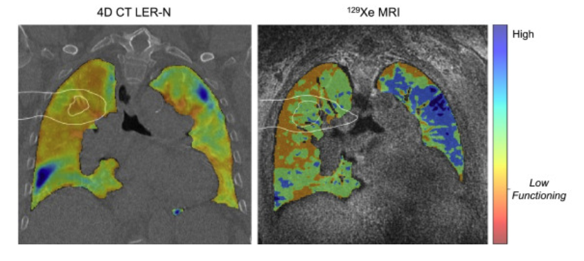 drdavidpalma's tweet photo. Interesting case report in the Green Journal showing lung function changes after SBRT - you can see how the contralateral lung compensates.

A similar effect was shown for locally advanced disease previously by Grace Parraga's team.
#sparetheotherlung https://t.co/IZ2lXN93XN