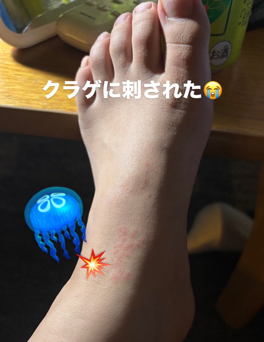 海入ったらクラゲに刺された！！指の皮もしわしわ！