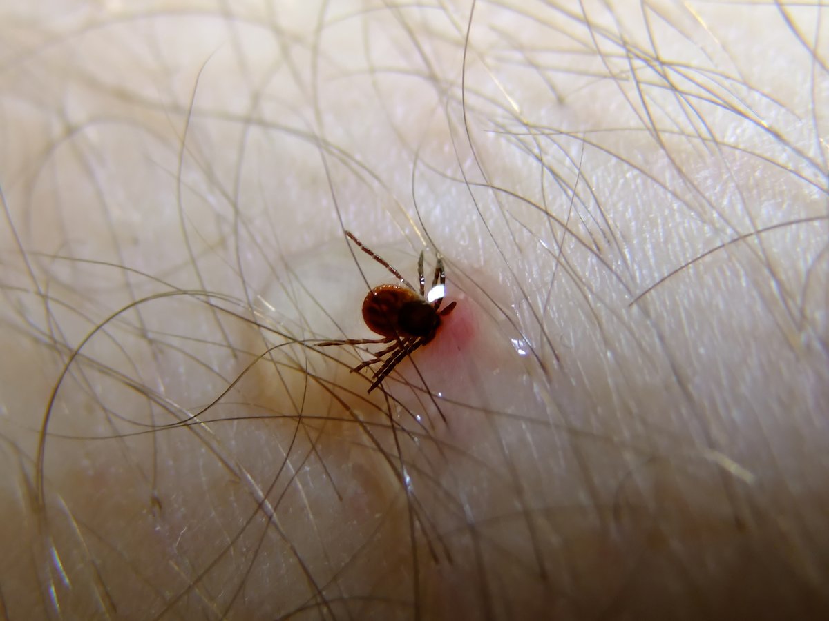 It’s Lyme disease season. Do you know how to remove an attached tick from your skin? Learn how at eohu.ca/ticks