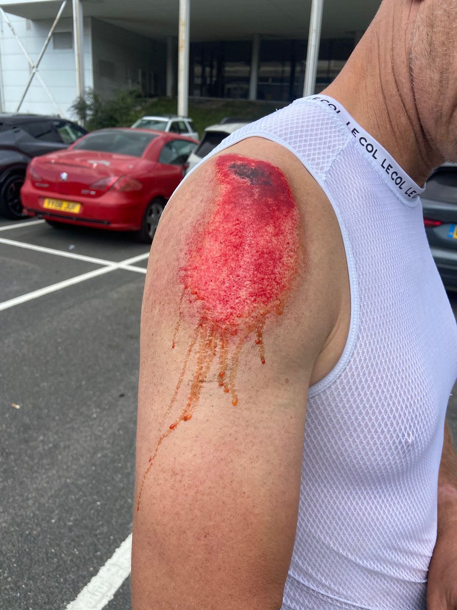 Crashing at 60kph… not a great start to the bank holiday 🤦‍♂️ However, super easy to reframe as it seems with this small sample size, going faster breaks less bones! Clean full break of the clavicle and then donating a load of my skin to the tarmac 🫣 
Could be worse…