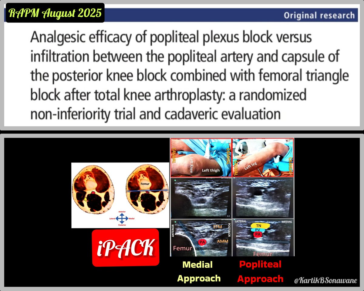 📑 Rethinking Posterior Knee Blocks in TKA: Lessons from the PPB vs IPACK Trial 🎯📈

#RegionalAnesthesia #TKA #KneeSurgery #PostoperativePain 
#PoplitealPlexusBlock #IPACK #FemoralTriangleBlock #AdductorCanalBlock #DualSubsartorialBlock #TipOfTheDay #MyRATips

Tip of the Day: