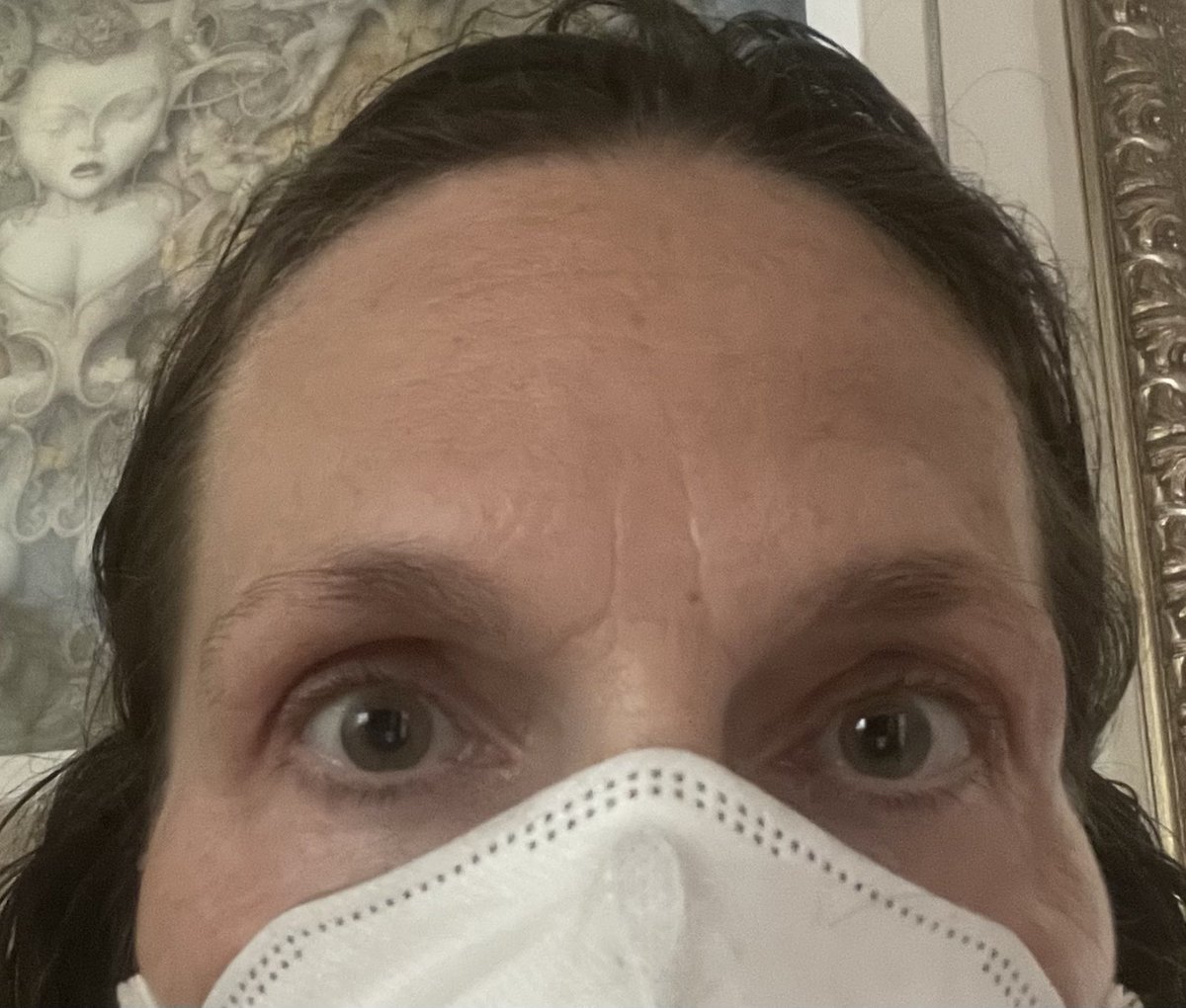 After 2 Pemgarda + 3 IVIG transfusions my ptosis (drooping upper eye lids) returning to pre-infection. Collage is ‘22 before/during/after +PCR. May ‘25 before IVIG and today.