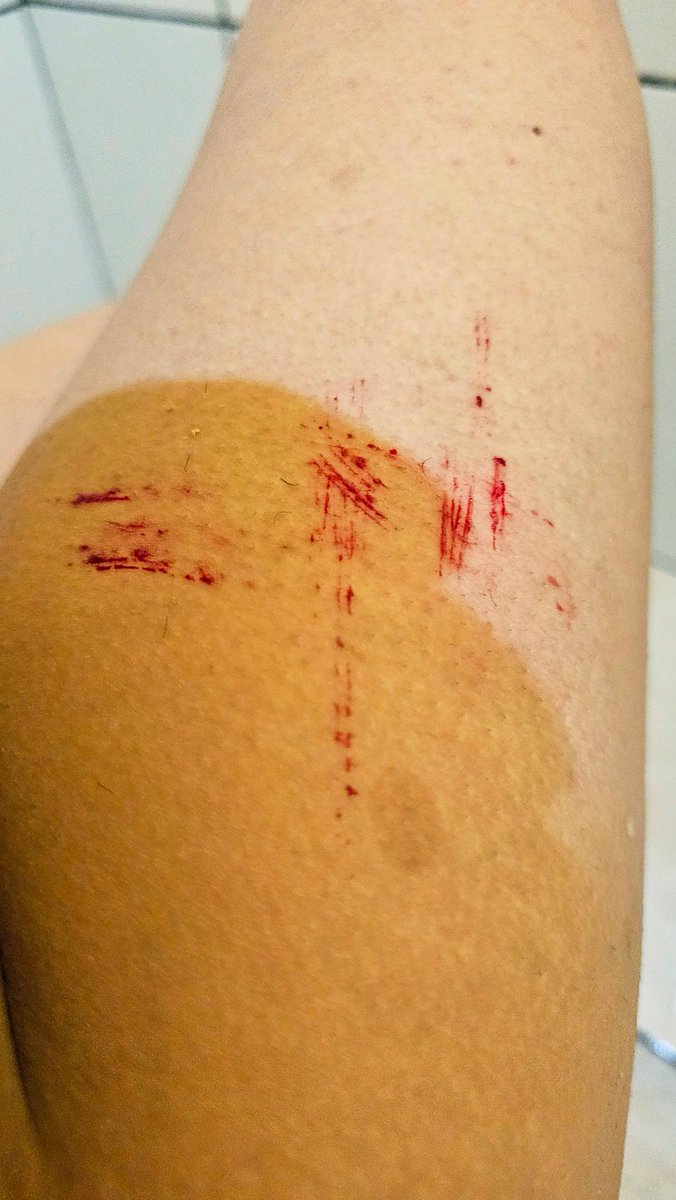 DahSissy's tweet photo. Adoro knife e blood play

#bloodplay #knifeplay

#impactplay #extremebdsm #cdzinha #sissy #femboylegs https://t.co/UdZ07LG36g