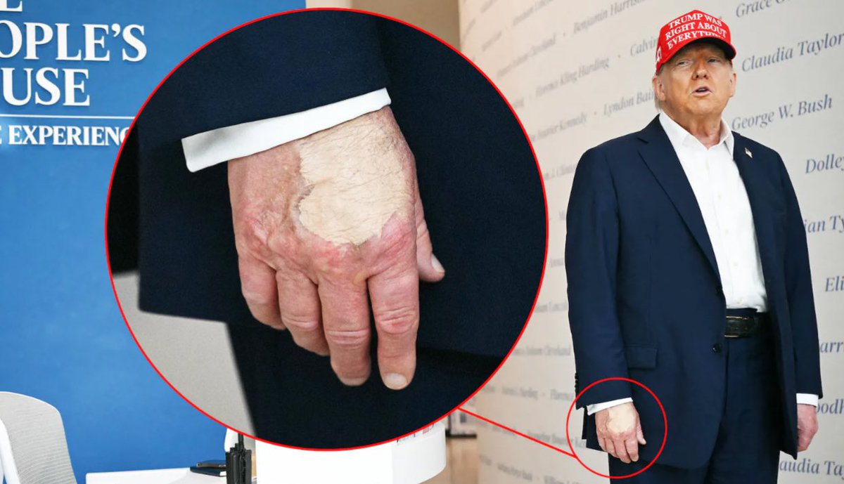 Impeach Trump a 3rd Time! (@christo12919382) on Twitter photo <a href="/Mollyploofkins/">Molly Ploofkins</a> He was getting these treatments well over 18 months ago, so yes. EVERYONE knows trump is dying.. <a href="/Mollyploofkins/">Molly Ploofkins</a> He was getting these treatments well over 18 months ago, so yes. EVERYONE knows trump is dying..