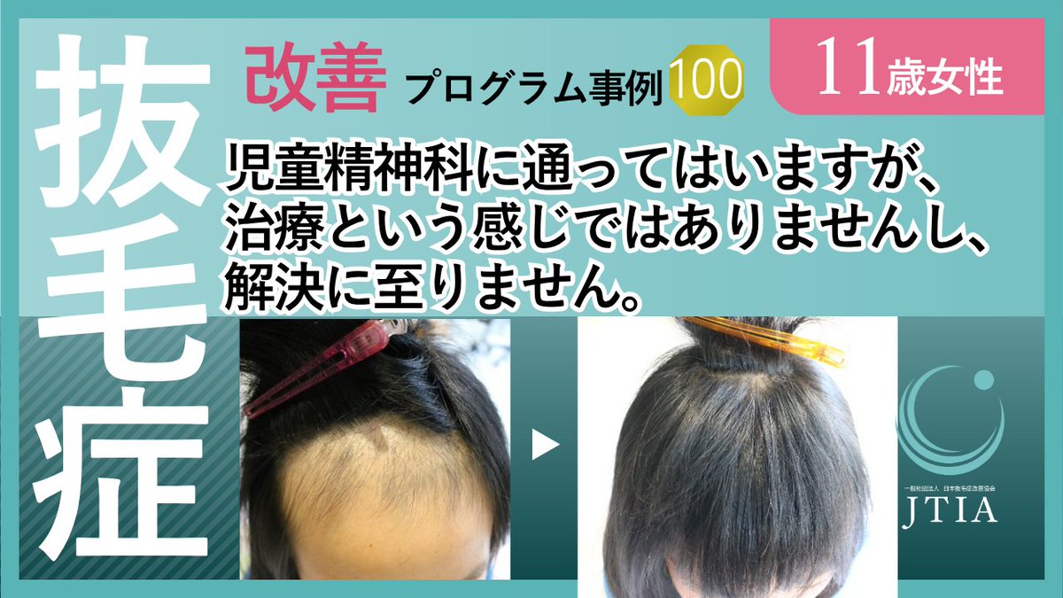 tricho_jtia's tweet photo. ★抜毛症改善事例100：11歳女性：初回カウンセリングの時にここなら治るかも？と思えた。 https://t.co/buIEAUcWhQ https://t.co/sBIw3z8lfY