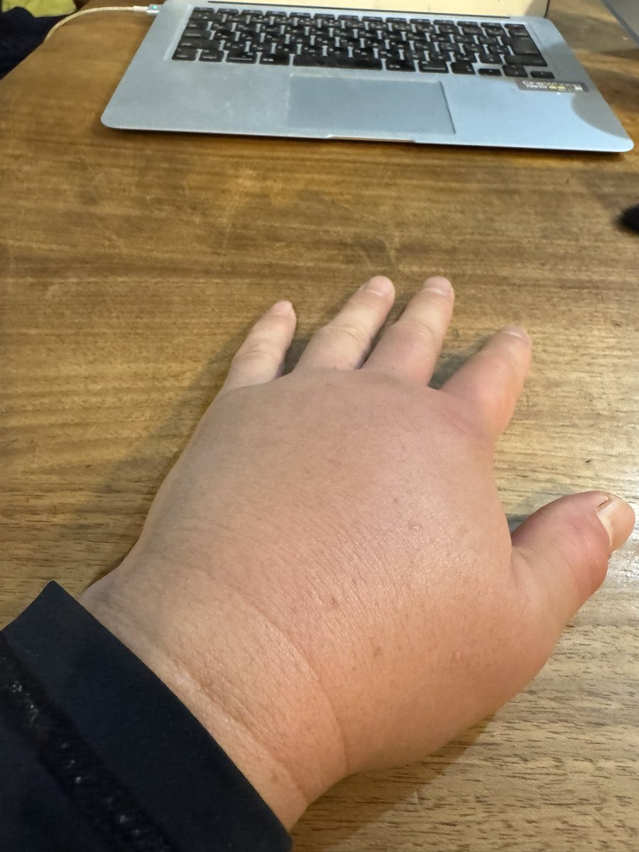 #カミキリモドキに
噛まれたワイの手見て
もうドラえもんやん😎