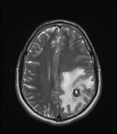 Issue 1: Neurocysticercosis

The image is an MRI scan of a patient with neurocysticercosis which was sourced from radiopaedia.org. The patient is a 20 year old male.

Now let’s dig into symptoms and how can one face this issue.

Symptoms:
• seizures: due to irritation in