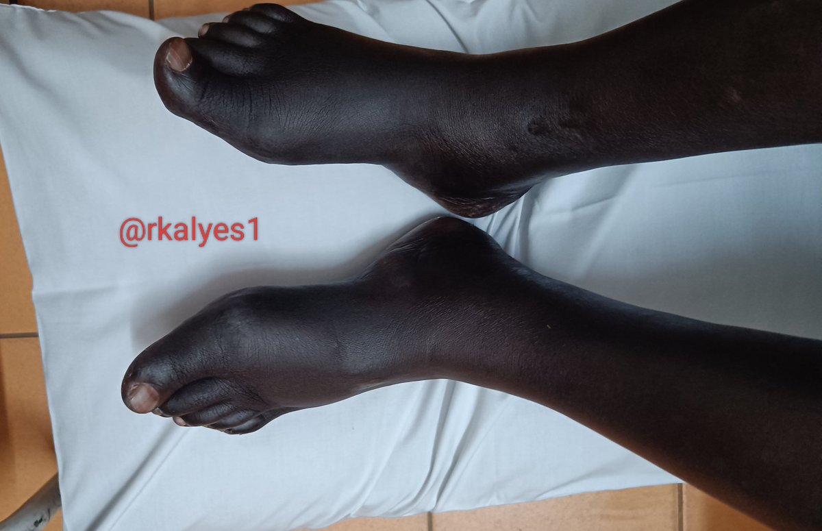 🏥 Dr, I was given a drug for pimples.
"Now all my skin has turned dark"

👉 What is the diagnosis?

🔥 What is the likely culprit?

<a href="/DrOribaDan/">Dr. Oriba Dan Langoya</a> 
<a href="/ChefKarim02/">ChefKarim02</a> 
<a href="/TSM_Humanist/">Tariq Mir 🇵🇰</a> 
<a href="/DrAkhilX/">Dr. Akhil 🇮🇳</a>