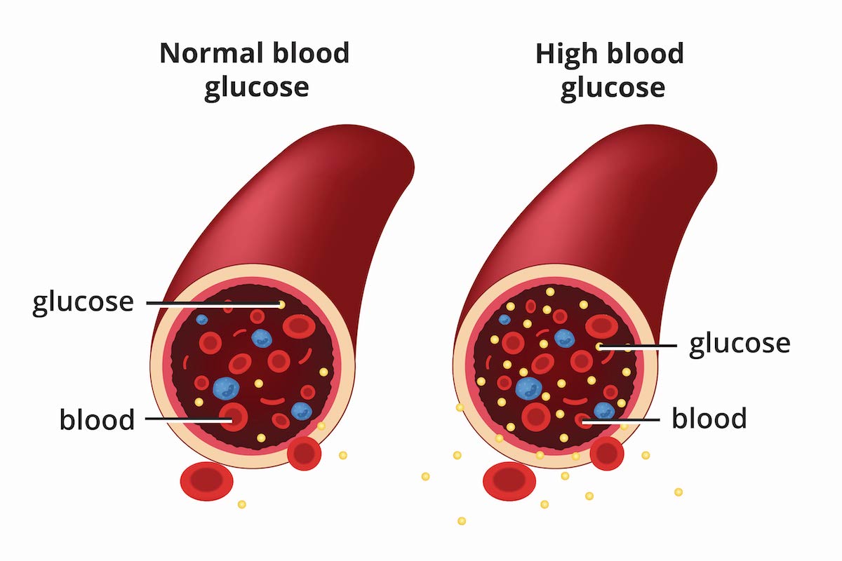 Diabetes doesn’t start overnight.

It builds silently for 10+ years before diagnosis.

The worst part? Millions already have it and have no clue.

It drains your energy, wrecks metabolism, and stores fat.

Here’s what's happening (and how to spot it early): 🧵