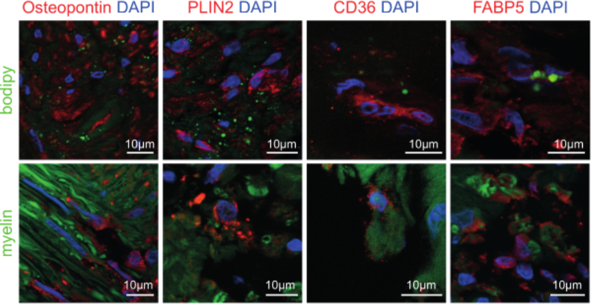 9/13 LAM markers (SPP1/osteopontin, PLIN2, CD36, FABP5) colocalized histologically with myelin and BODIPY (labels neutral lipids). LAM thus likely has myelin-phagocytizing capacity.