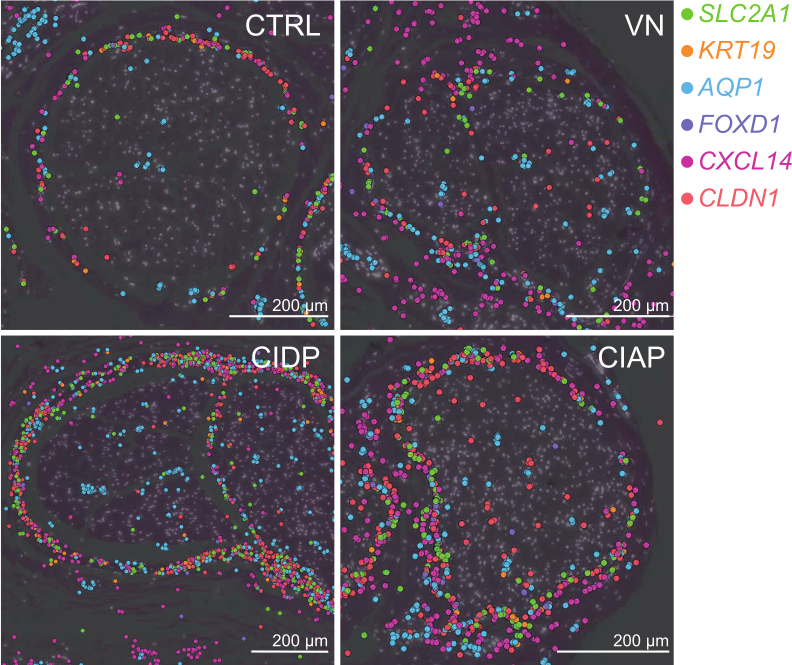 12/13
PNPs showed previously unknown perineurial hyperplasia and fibrotic dispersion and this was most pronounced in immune-mediated PNPs.