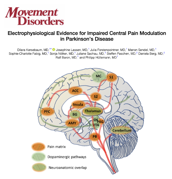 MichaelOkun's tweet photo. Are we beginning to understand the conversations your brain is having during Parkinson's pain?  Do we know why pain in Parkinson’s is different? Even people with Parkinson’s who say they are not in pain may still show abnormal brain pain responses. Pain in Parkinson’s has long been overlooked, however new evidence shows the brain itself may struggle to turn down the volume on 'painful signals.' Using electrophysiology, researchers have uncovered altered central pain modulation in people w/ Parkinson’s, even in those who did not report pain. This work deepens our understanding of why pain is so common and difficult to treat in Parkinson’s.
Key Points:
- Persons w/ Parkinson’s showed impaired habituation to repeated painful stimuli, a sign of disrupted central pain modulation.
- This abnormal brain response occurred regardless of whether persons reported having pain.
- The findings suggest central sensitization mechanisms may be at play in Parkinson’s.
- This highlights some of dopamine’s role in pain pathways.
My take: If we are to treat Parkinson's pain we must make the investment to understand its pathways. Here are 5 points that resonated w/ me about this article. 1-Pain in Parkinson’s is not just in the body, it is also in the brain’s pain networks. 2- The brain normally gets used to repeated pain, however in Parkinson’s this process is disrupted. 3- Even people with Parkinson’s who say they are not in pain may still show abnormal brain pain responses. 4- Understanding these brain changes can help us to develop better pain treatments tailored to Parkinson’s. 5- Recognizing pain as part of Parkinson’s will be essential for developing therapeutics.
https://t.co/0SB72O0e7f #parkinson @ParkinsonDotOrg @PainAssocScot @painsociety @FixelInstitute @movedisorder @SfNtweets @MDJ_Journal