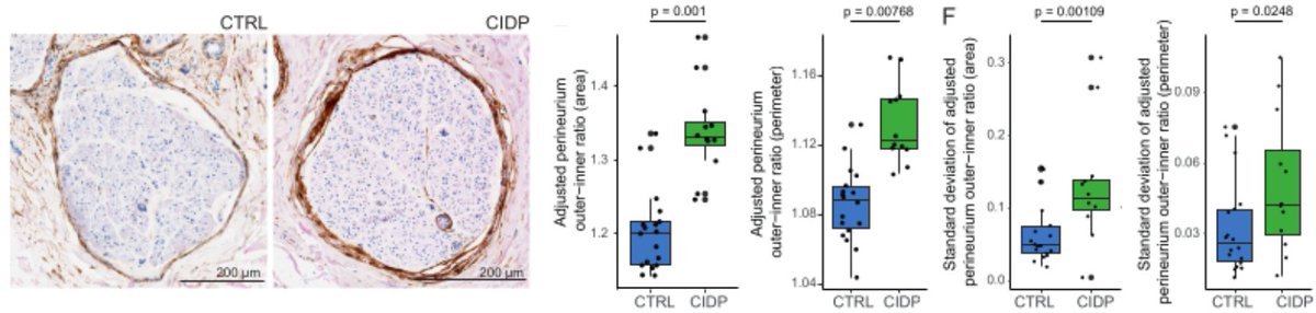 13/13 Validated in a larger cohort (370 fascicles; 18 CTRL, 12 CIDP): manual perineurium measurements. Linear mixed model (age+sex fixed, center/sample random) showed perineurial area &amp; perimeter increased in CIDP.