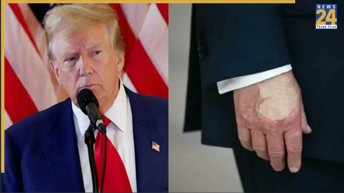 News24eng's tweet image. Foundation Or Cover-Up? Trump’s ‘Swollen’ Right Hand Draws Attention! Makeup Patch Ignites Health Debate

READ MORE➡️tinyurl.com/52vayr7h

#TrumpHealth #SwollenHand #DonaldTrump