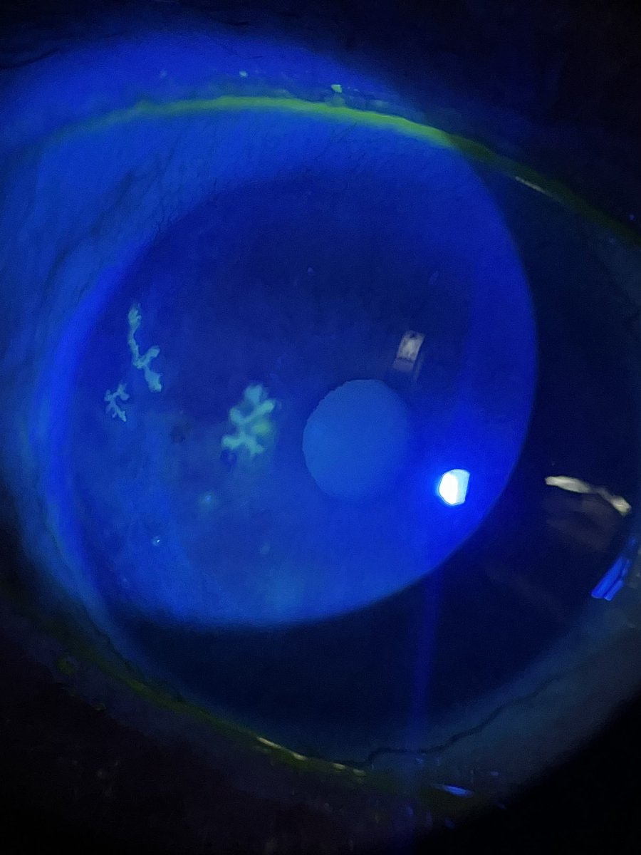 Dendritic Keratitis ❄️

1️⃣ Branching epithelial ulcer with terminal bulbs = classic sign

2️⃣ Steroids worsen → geographic ulcer

3️⃣ Reduced corneal sensation

4️⃣ Treat with antivirals, not antibiotics

5️⃣ Recurs often → consider oral prophylaxis
#Ophthalmology #medtwitter