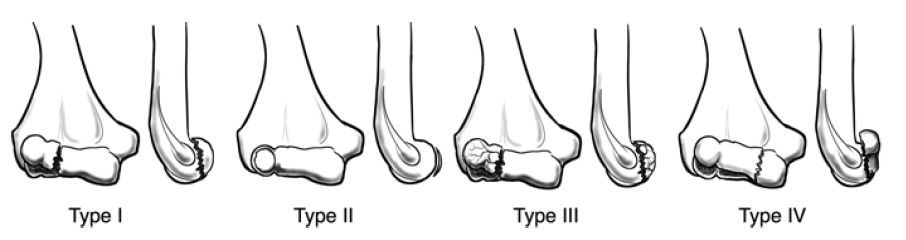 MoAImam's tweet image. Four Types of Capitellum Fractures (Bryan and Morrey Classification)
Type I — Complete osteochondral (Hahn-Steinthal) fracture
Type II — Anterior osteochondral with minimal subchondral bone (Kocher-Lorenz)
Type III — Comminuted compression (Grantham) fracture
Type IV — Coronal…