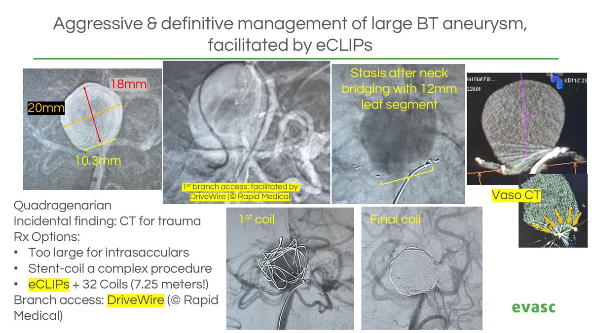 <a href="/_AdnanSiddiqui/">Adnan H. Siddiqui, MD</a> <a href="/SNISinfo/">SNIS Info</a> <a href="/Rapid__Medical/">Rapid Medical</a> DriveWire assisted management of huge BT aneurysm, eCLIP'd with 12mm eCLIPs, and densely coiled