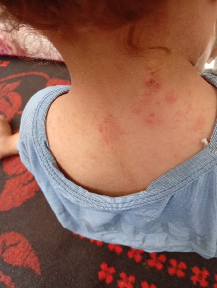 Gazan family in pinned tweet! (@kat_zoe) on Twitter photo Ahmed (<a href="/mad05999/">Ahmed Emad Gaza 🇵🇸🍉</a>) reached out today begging me to cover the cost of their medicine
🚨His entire family is covered in a painful rash🚨
I have to now beg you to help
I can’t save them alone
And they can’t wait
G0al: $219 / $750 USD‼️ for medicine
chuffed.org/project/118420 Ahmed (<a href="/mad05999/">Ahmed Emad Gaza 🇵🇸🍉</a>) reached out today begging me to cover the cost of their medicine
🚨His entire family is covered in a painful rash🚨
I have to now beg you to help
I can’t save them alone
And they can’t wait
G0al: $219 / $750 USD‼️ for medicine
chuffed.org/project/118420