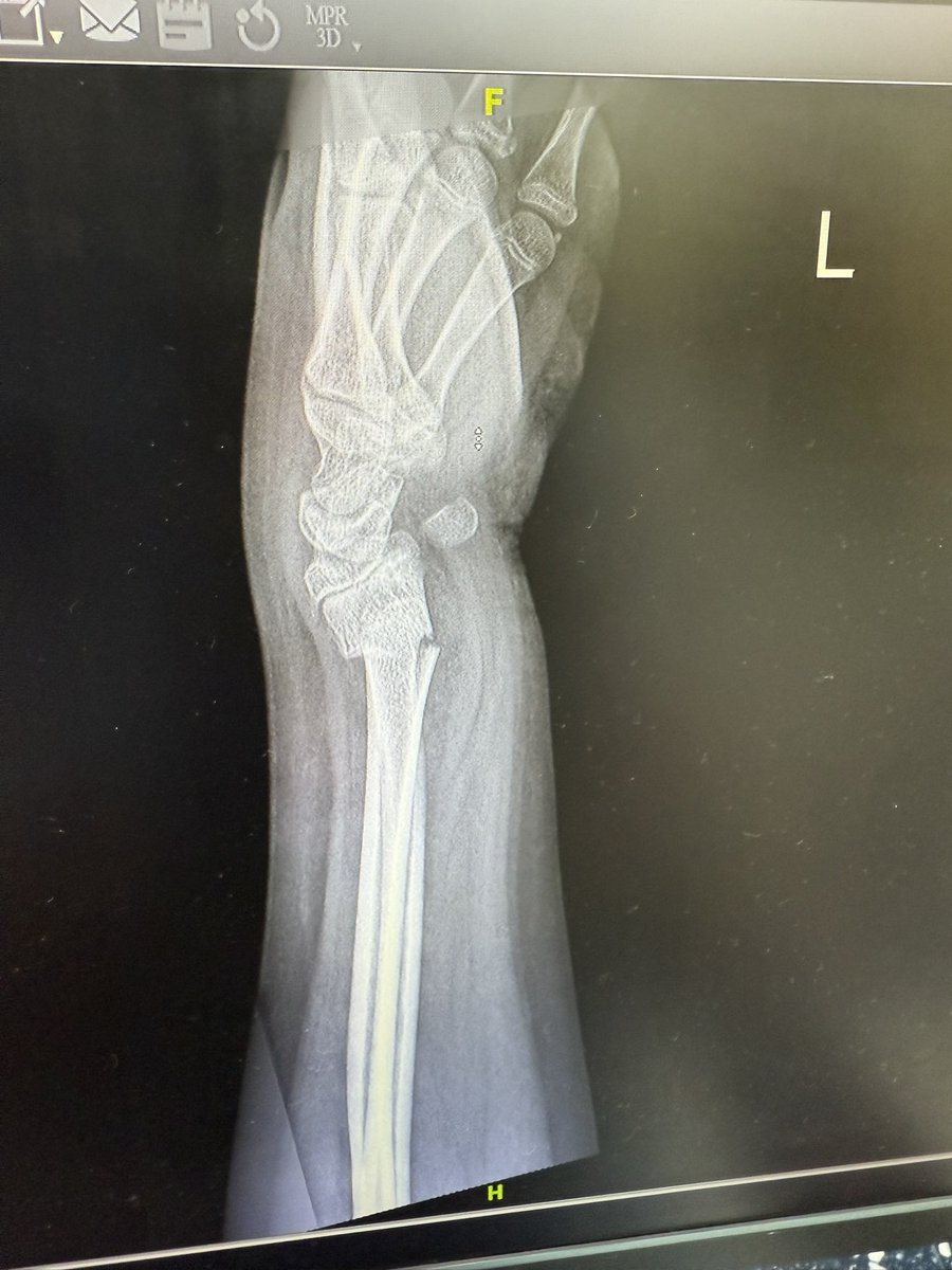 Dx  
If u will examine only 2 parts which tell u that motor and sensory intact or not and how 
What r they?