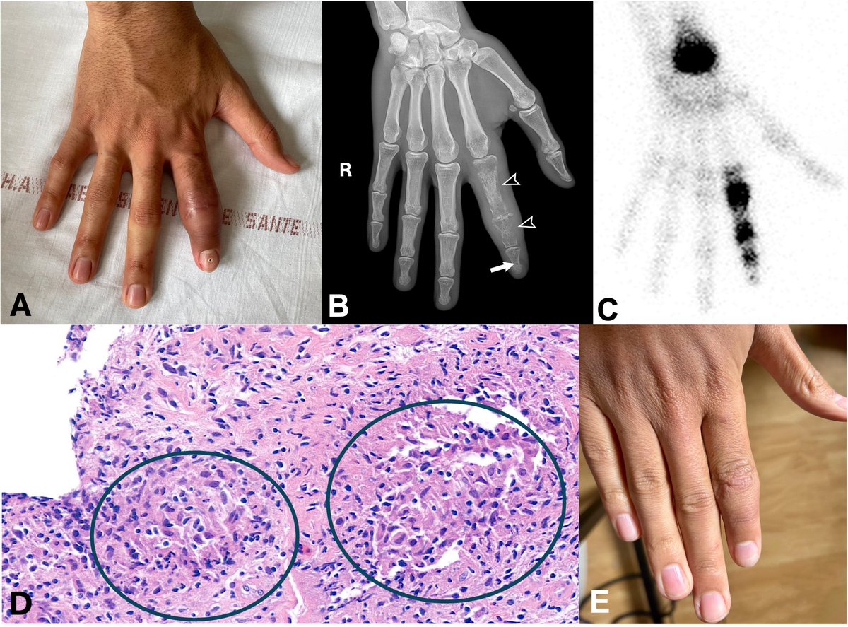 ACR_Journals (@acr_journals) on Twitter photo A 21-year-old man presented with recurrent dactylitis of the index finger (A). Radiography showed osteolytic changes in phalanges of the right index finger, with a honeycomb (or lattice) appearance in P1 & P2 (B, arrowheads), and cystoid lesion in P3 (B, arrow), with thickening A 21-year-old man presented with recurrent dactylitis of the index finger (A). Radiography showed osteolytic changes in phalanges of the right index finger, with a honeycomb (or lattice) appearance in P1 & P2 (B, arrowheads), and cystoid lesion in P3 (B, arrow), with thickening