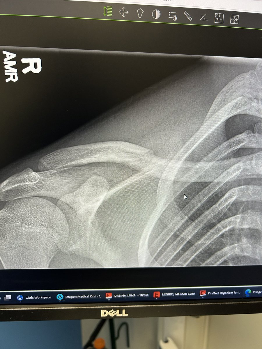 jm0rris4's tweet photo. Minor Setback for a Major Comeback ❤️‍🩹 https://t.co/SAIuEQi6Hn