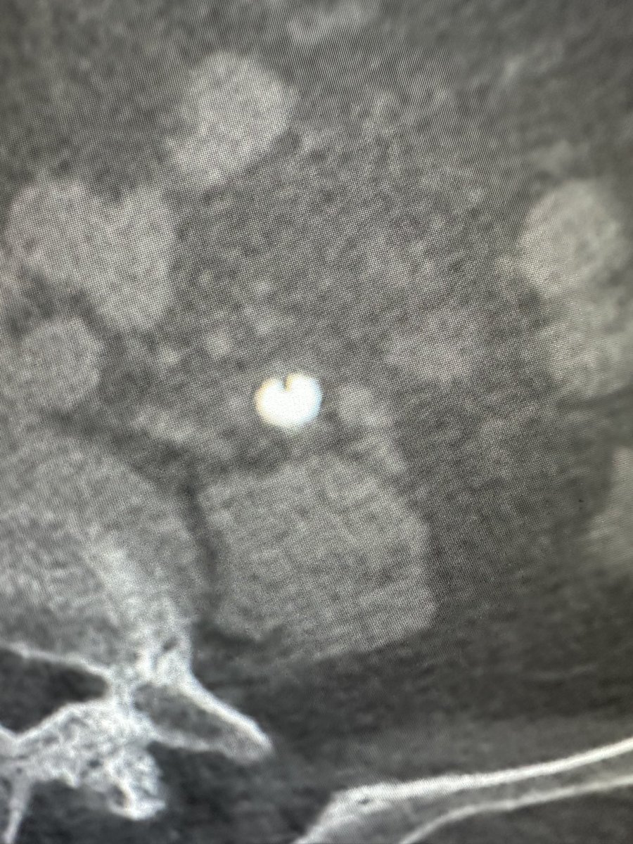 robsradiology's tweet photo. This renal stone loves you so much it wants you to notice its entire time with you :) https://t.co/iWszlFrGRE