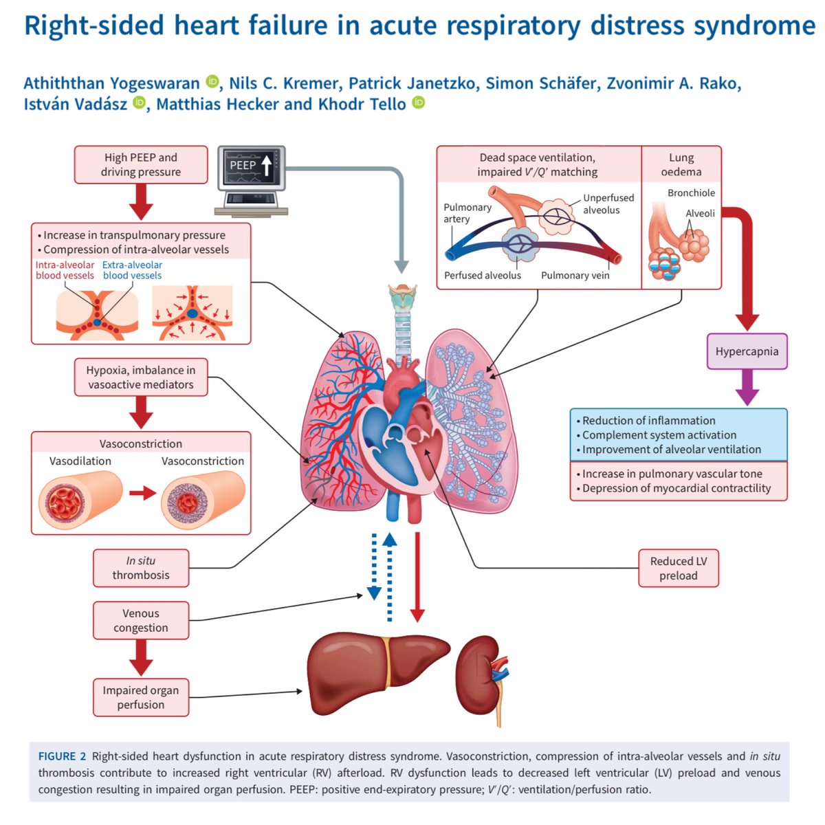 When patients go into ARDS, their right ventricle often takes a nap in the process. Here's why it often turns into a deleterious spiral, compromising other organs in its slumber. 🎩 tip to the authors.
eddyjoemd.com/foamed